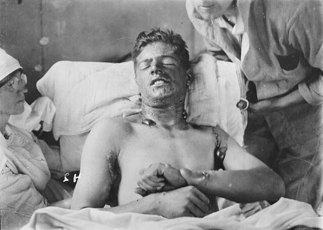 libia_mustard_gas_burns-1766039
